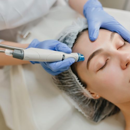 Microneedling in Hochheim am Main